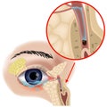 Blockage of the lacrimal canals. Dacryocystitis.